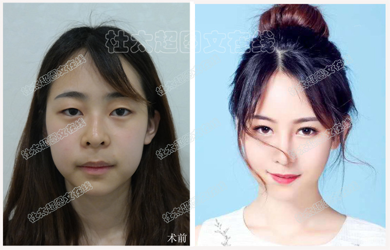 双眼皮 5.jpg