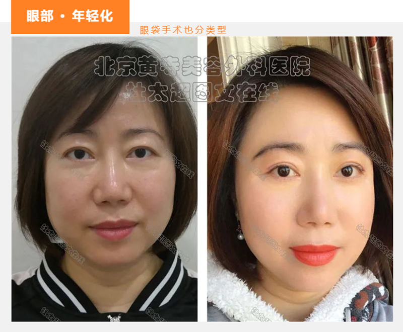 眼袋明显的他们都这么选？