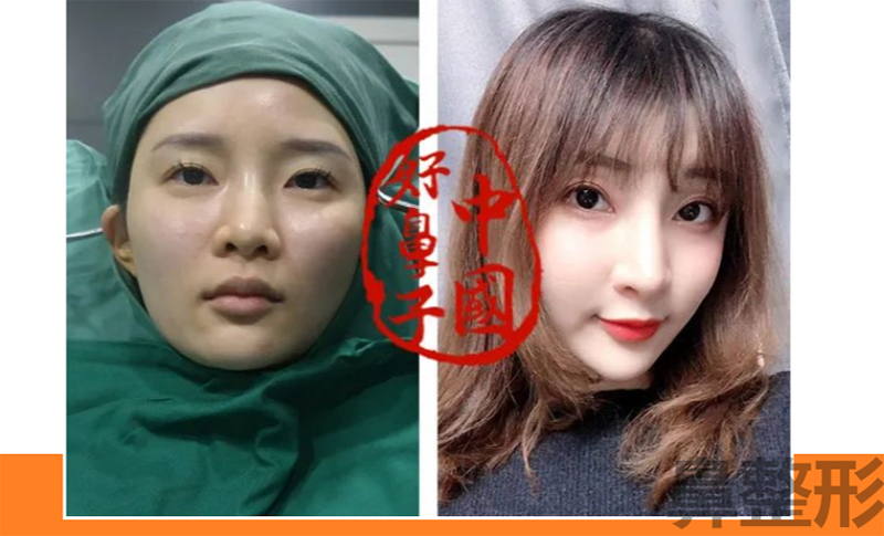 隆过的鼻经的起“风雨” 吗？