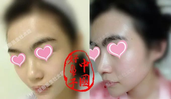 为什么会有“年抛鼻”这样的误解？