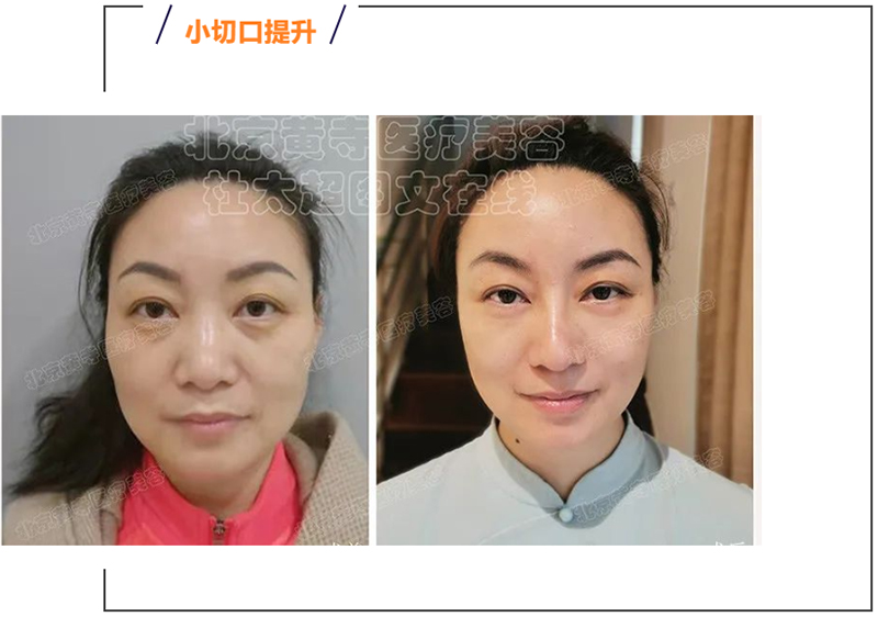 深度了解小切口拉皮！