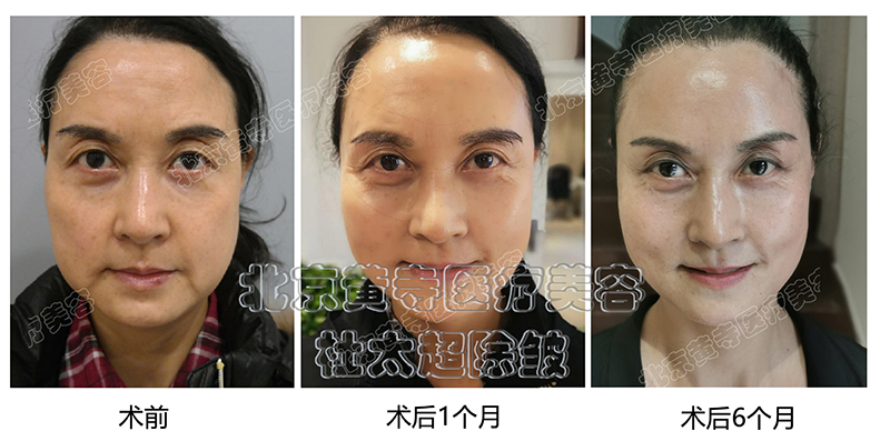 大拉皮小拉皮到底怎么选？
