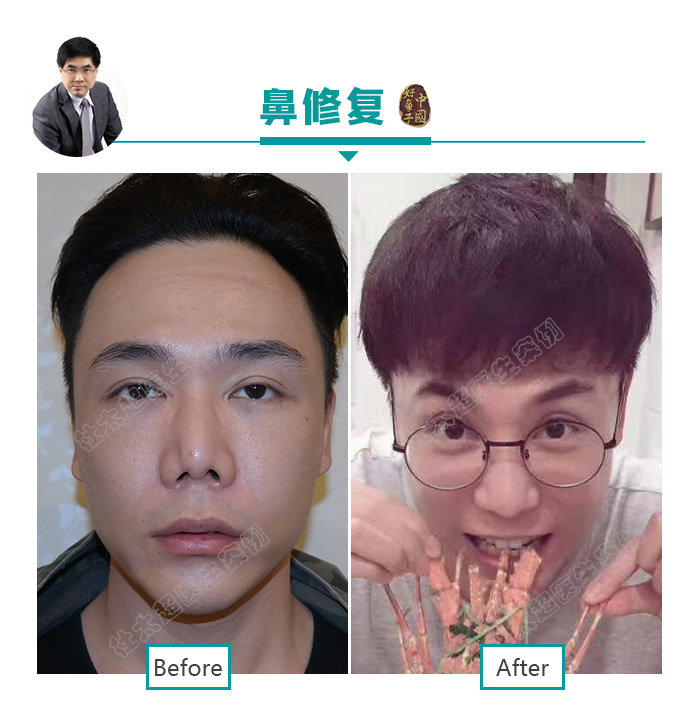 隆鼻、鼻整形并不是女性求美者的专利!