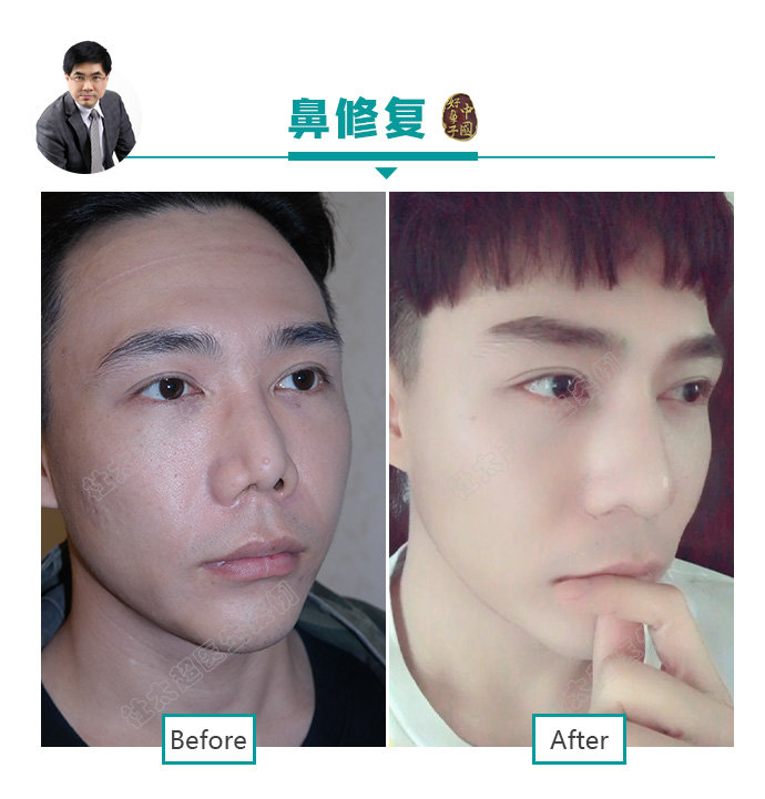 隆鼻、鼻整形并不是女性求美者的专利!