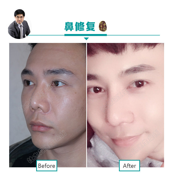 隆鼻、鼻整形并不是女性求美者的专利!