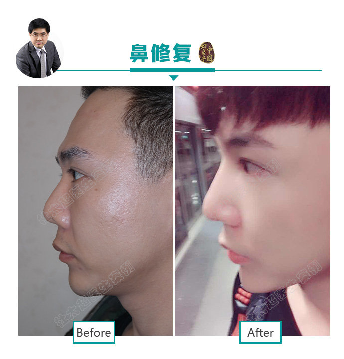 隆鼻、鼻整形并不是女性求美者的专利!