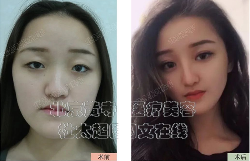 双眼皮手术您选对了吗？
