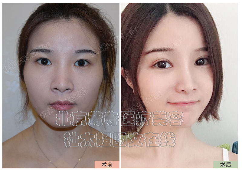双眼皮手术真的有必要面诊吗？
