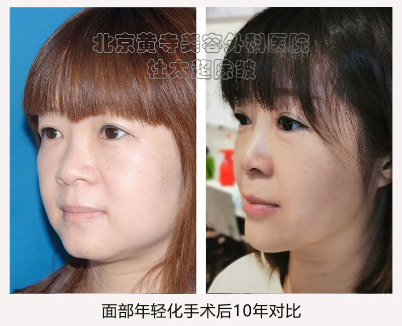 拉皮手术的时效性您有了解过吗？