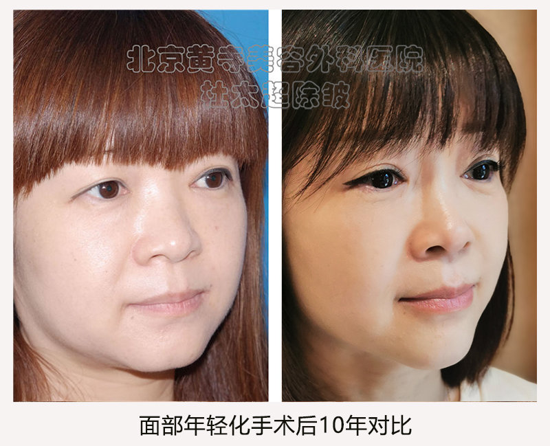 拉皮手术的时效性您有了解过吗？