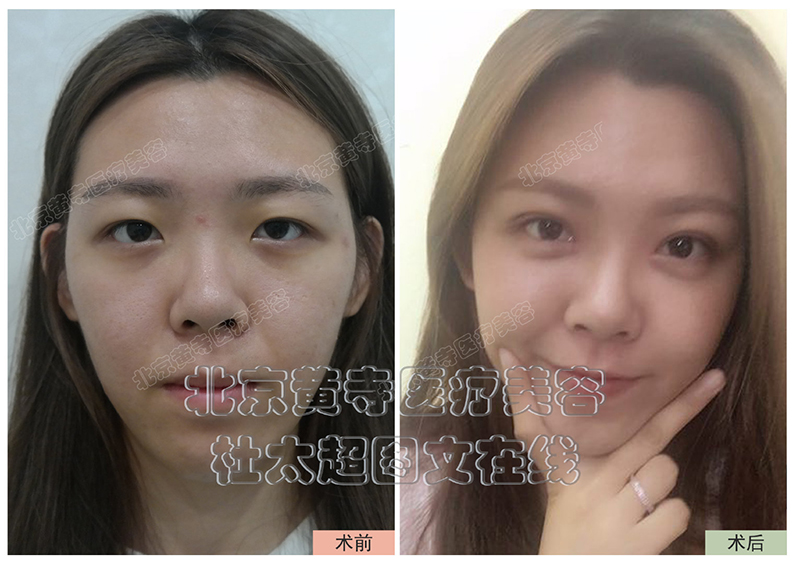 双眼皮刚拆线不对称怎么办？