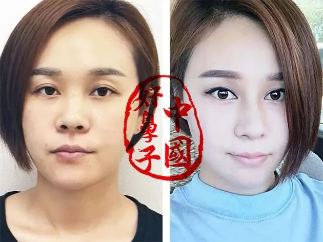 鼻整形要好看，必须考虑五官协调！