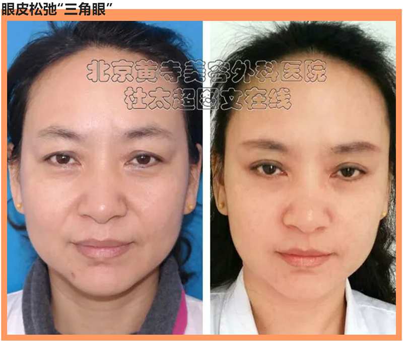 松弛的三角眼让很多人都扼腕叹息