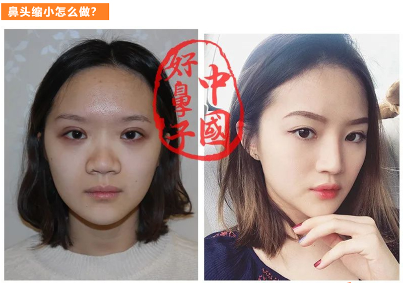 鼻头缩小术整个过程是怎样的呢？