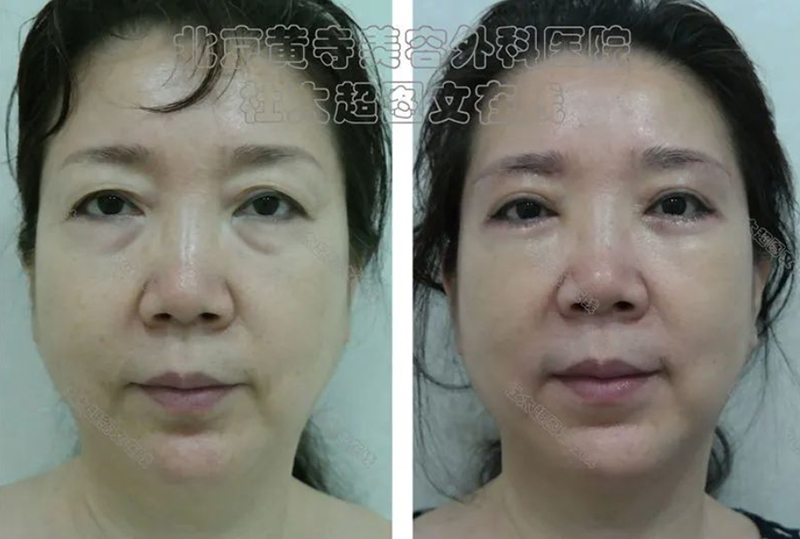 眼老化手术方法如何选择？