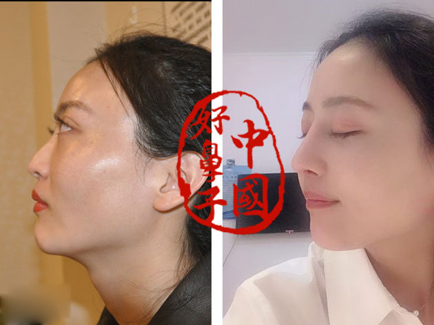 鼻子要求垫多高才算美呢?
