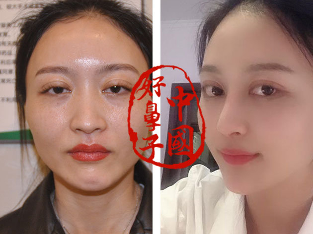 鼻子要求垫多高才算美呢?