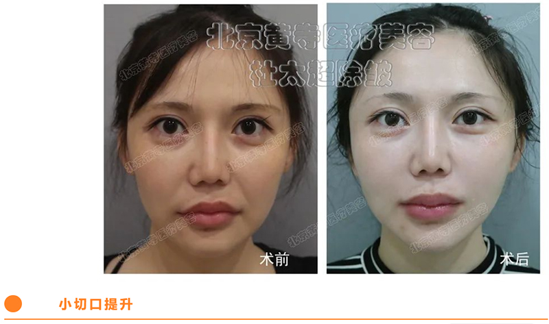 小切口拉皮真的适合30岁左右的人群吗？