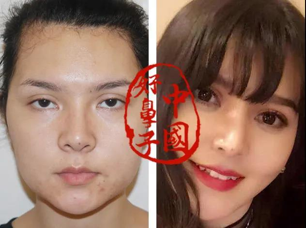 为什么有的人要做鼻综合？