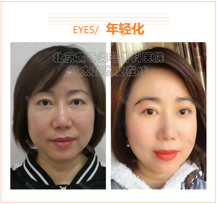 如何防止眼皮松弛？