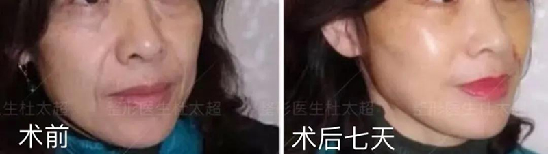 关于拉皮提升的一些建议！