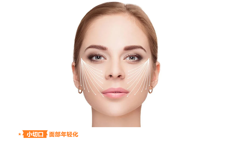 关于拉皮提升的一些建议！