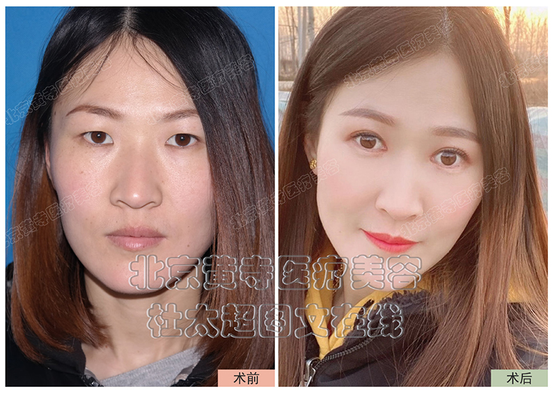 双眼皮后，这些小细节帮助你恢复的更快