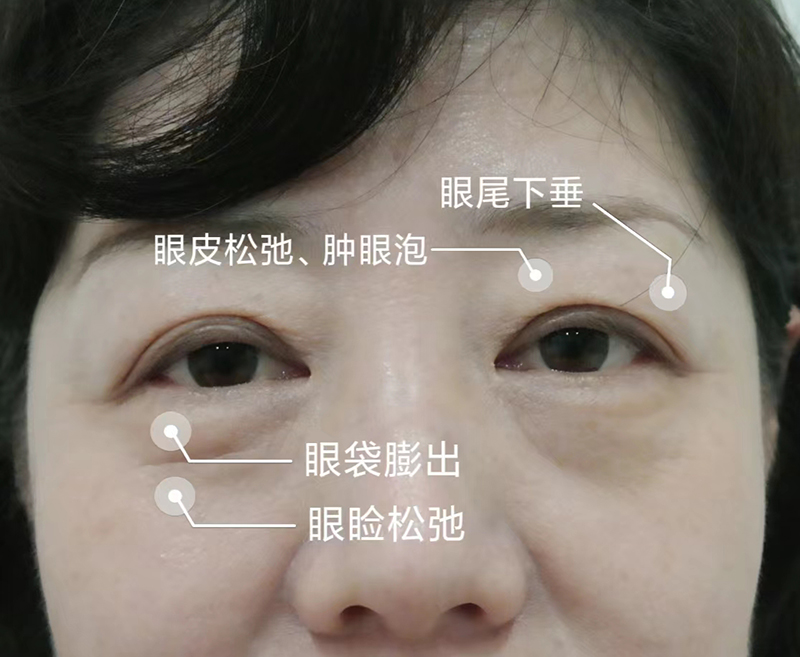 如何判断自己适合的眼周年轻化术式