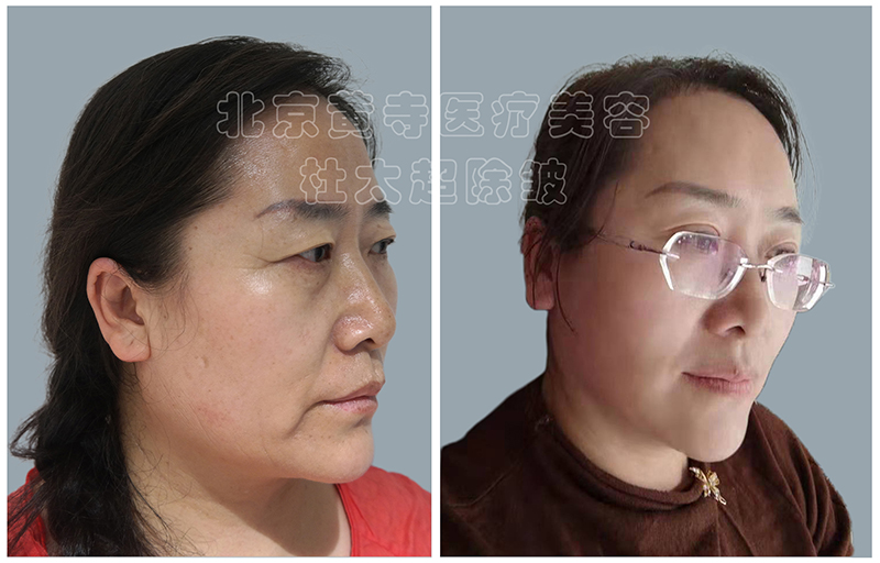 鱼尾纹出现怎么做？