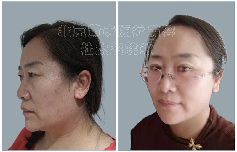 鱼尾纹出现怎么做？