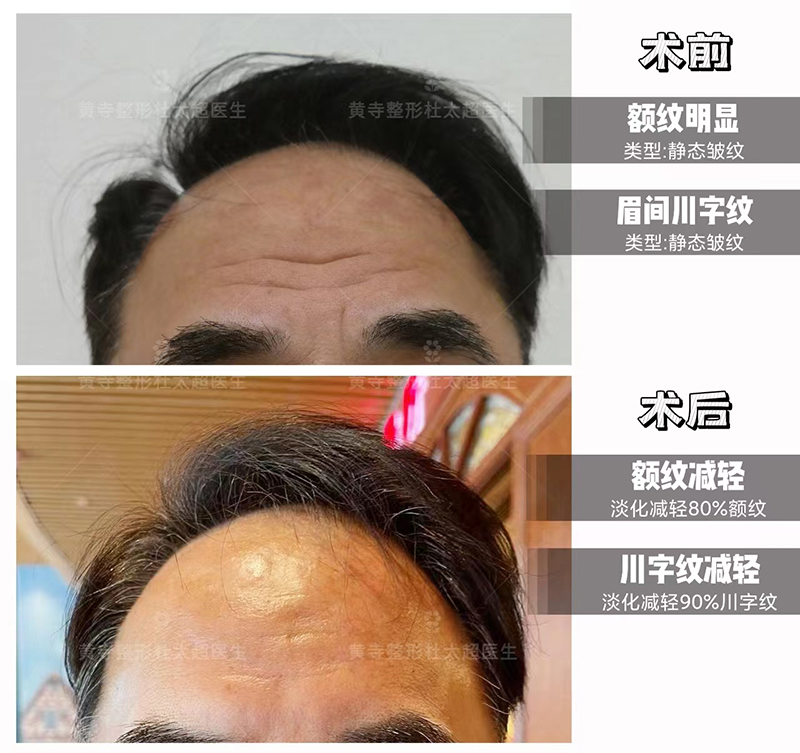抗衰要趁早