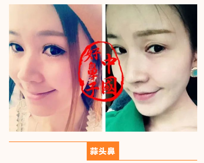 蒜头鼻整形一个月可以恢复吗？