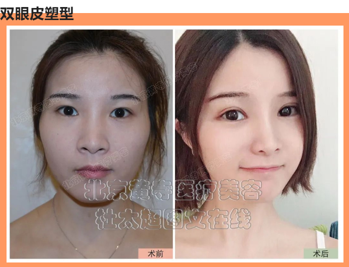 双眼皮塑型能改善哪些部位呢？