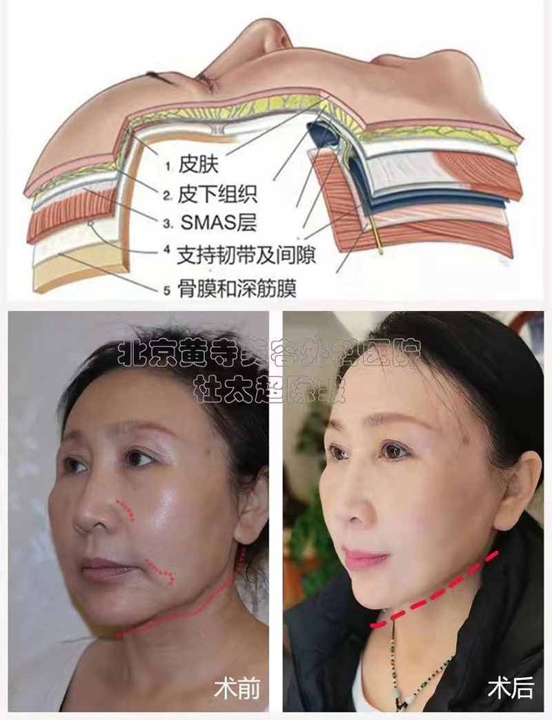 小切口拉皮知识点解析