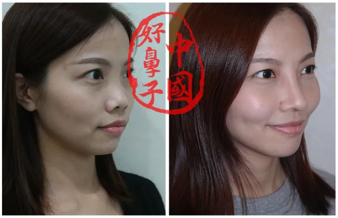 鼻整形——软骨那么多种，我该如何选？