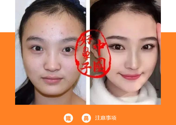 想做鼻子的您是否也有这样的顾虑？