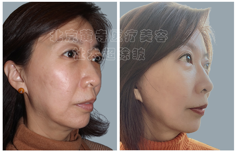 有什么好的改善方法？木偶纹三大改善方法