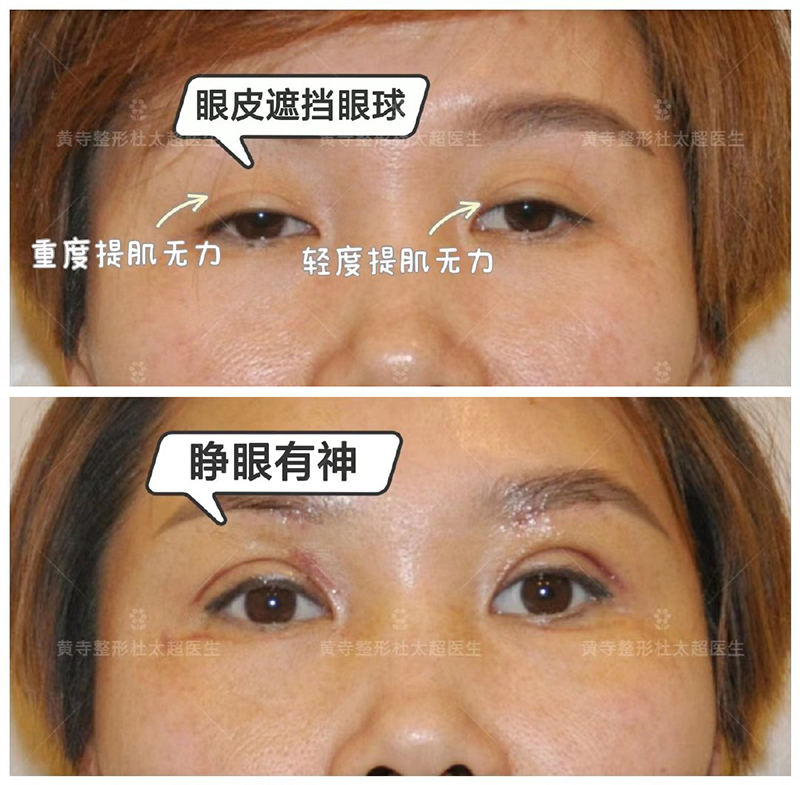 睁眼无力的解决方法