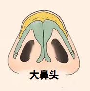 大鼻头缩小如何做？ 