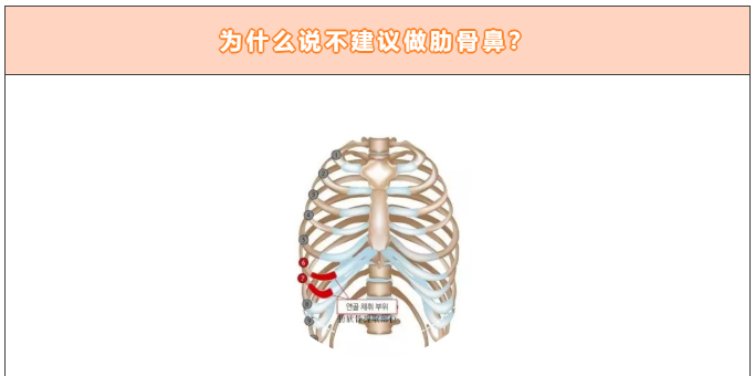肋软骨隆鼻你真的了解吗？