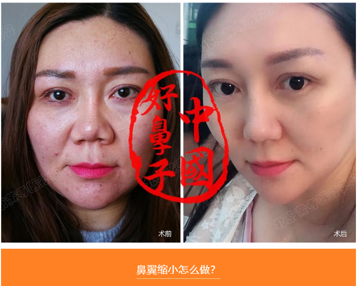 你需要做鼻翼缩小手术吗？