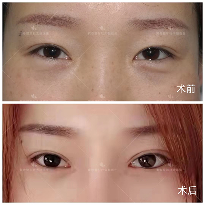 双眼皮+去眼袋，术后75天反馈图