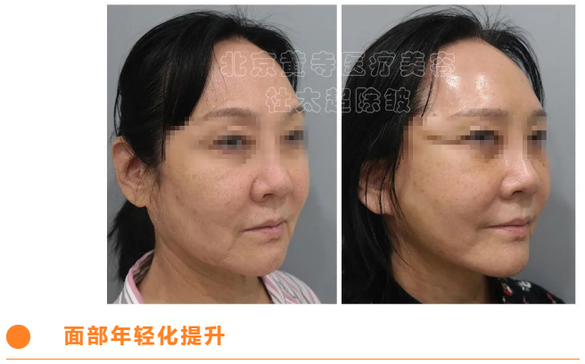 小切口提升的效果到底有多稳定？