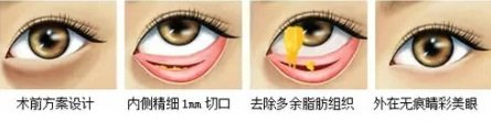 眼袋手术能解决多少个问题？