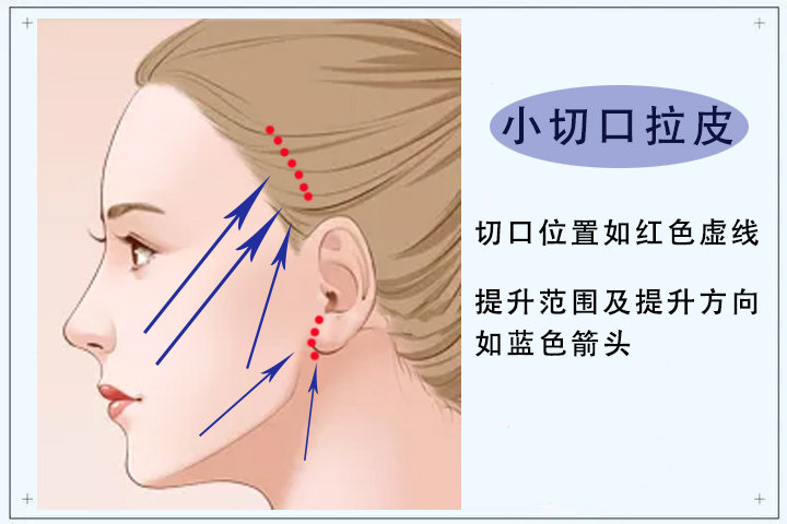 三分钟概览小切口拉皮！