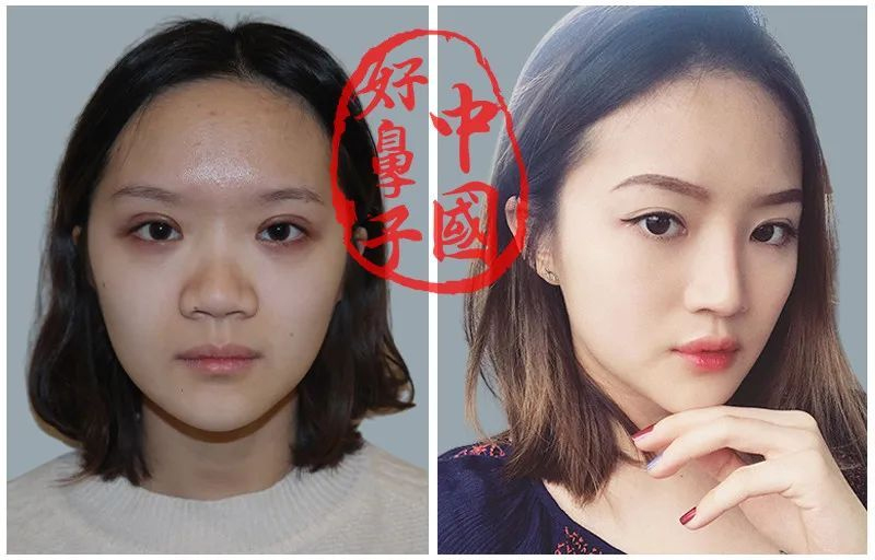 鼻子宽塌显老气怎么做？