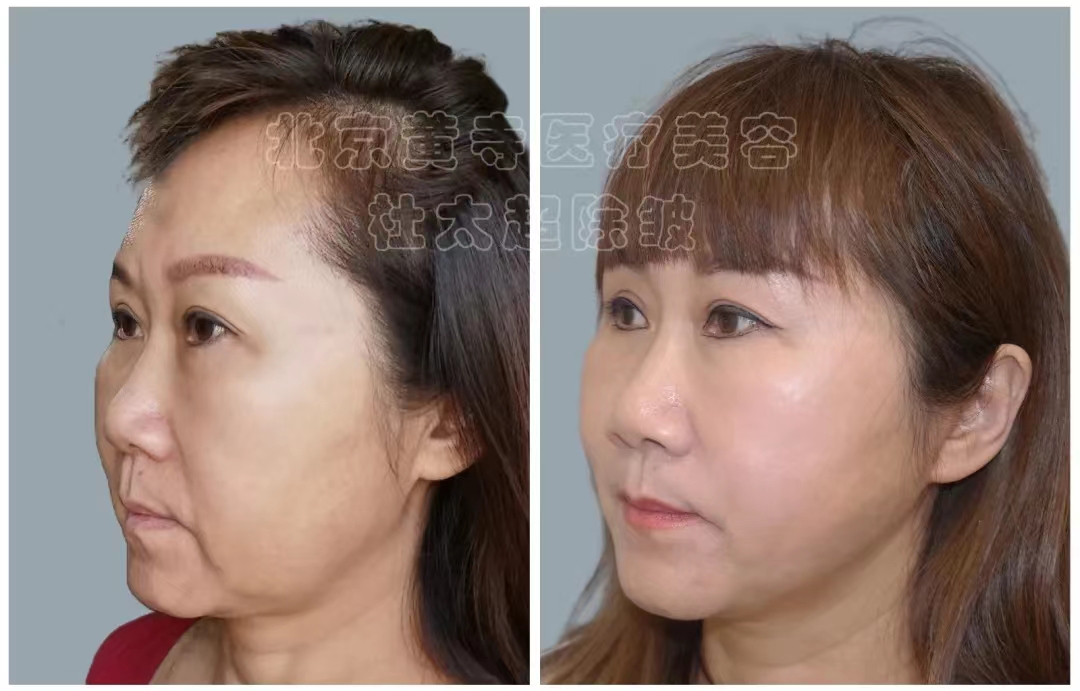 小切口拉皮真的是智商税吗？