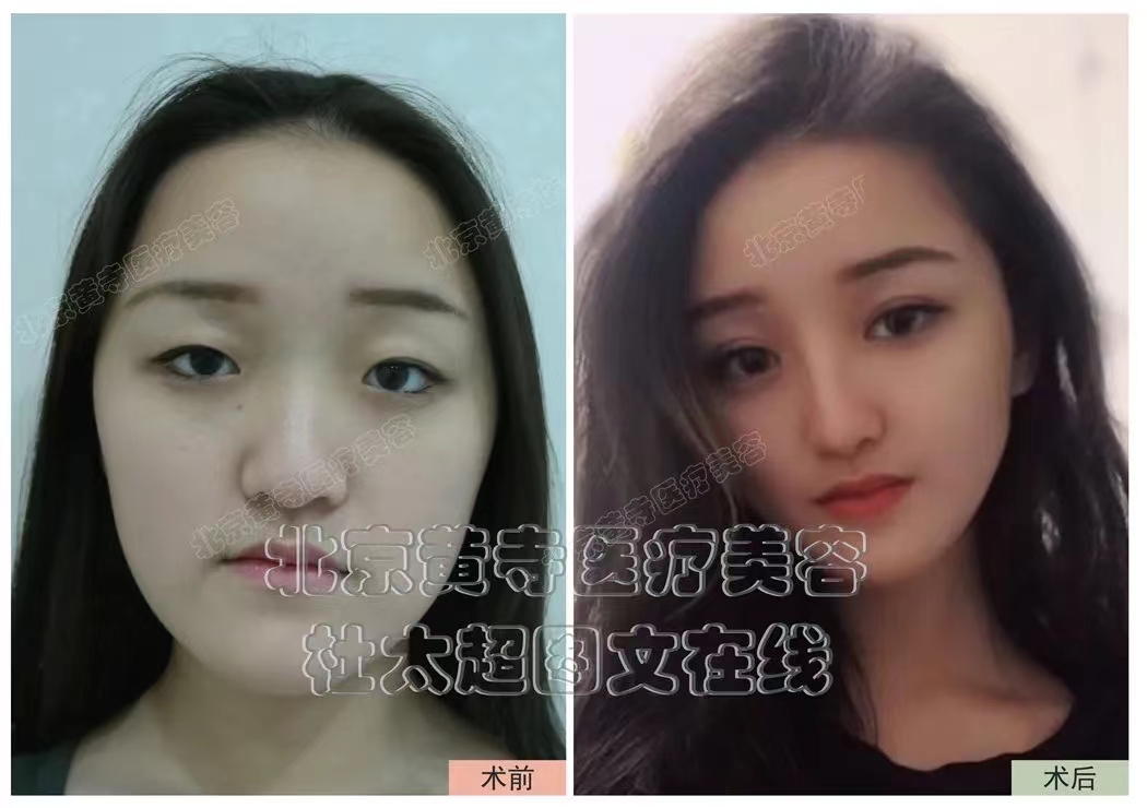 双眼皮的美学评判标准是什么？