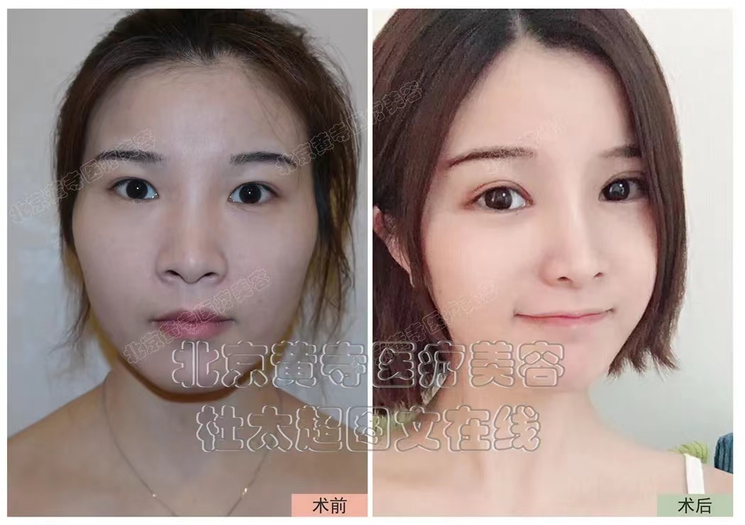 双眼皮常见的五种设计款，有您喜欢的吗？