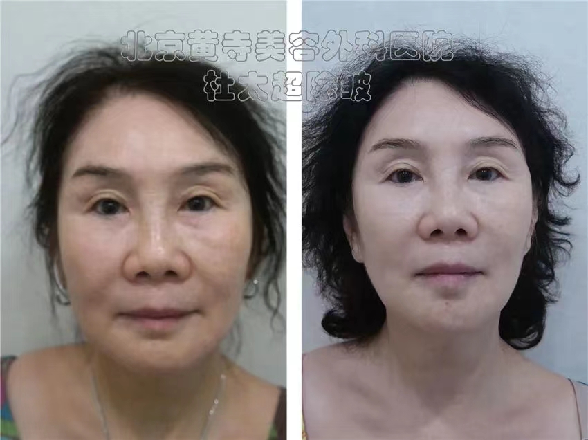 小拉皮常说的“筋膜层”到底是什么？